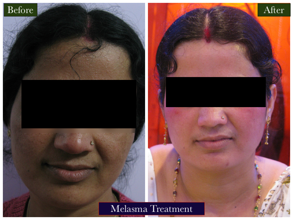 Melasma Treatment